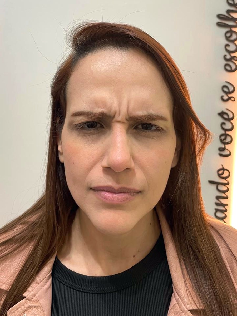 Toxina Botulínica