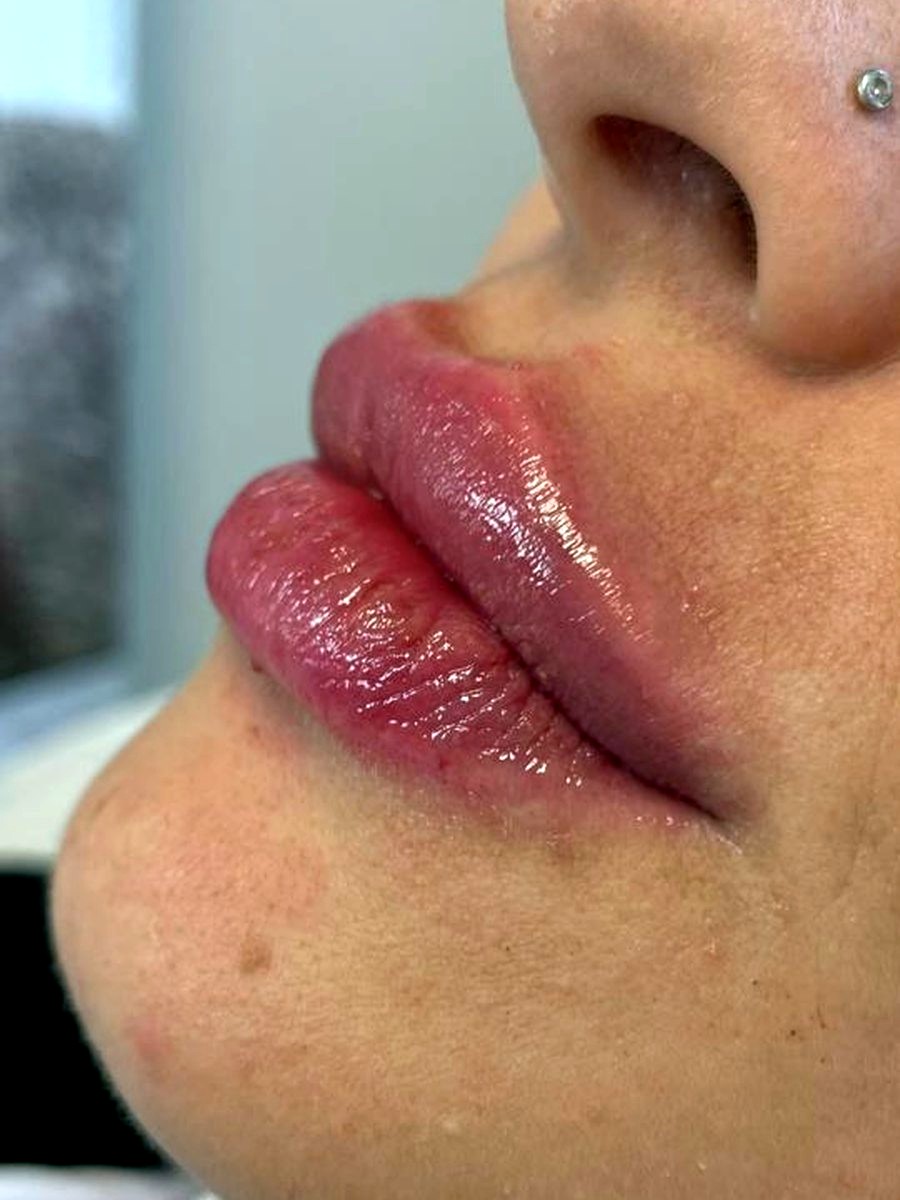 Preenchimento Facial